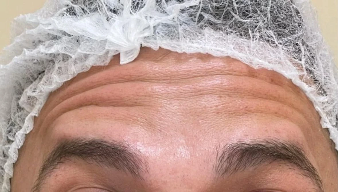 Região frontal antes do cuidado com toxina botulínica