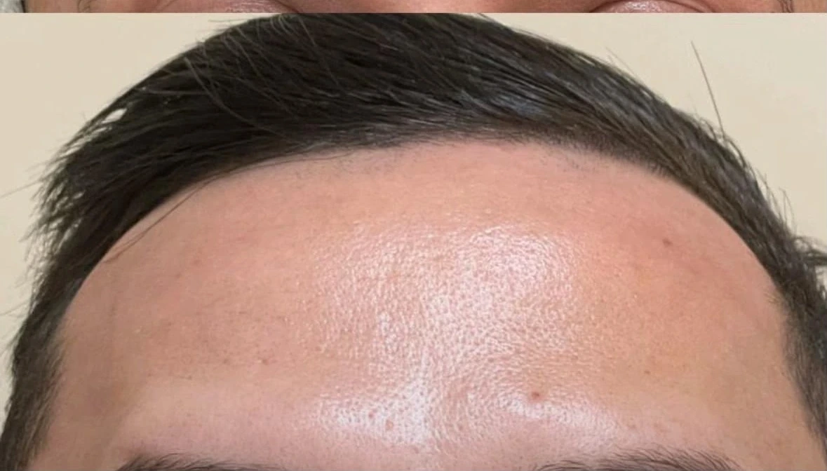 Região frontal depois do cuidado com toxina botulínica