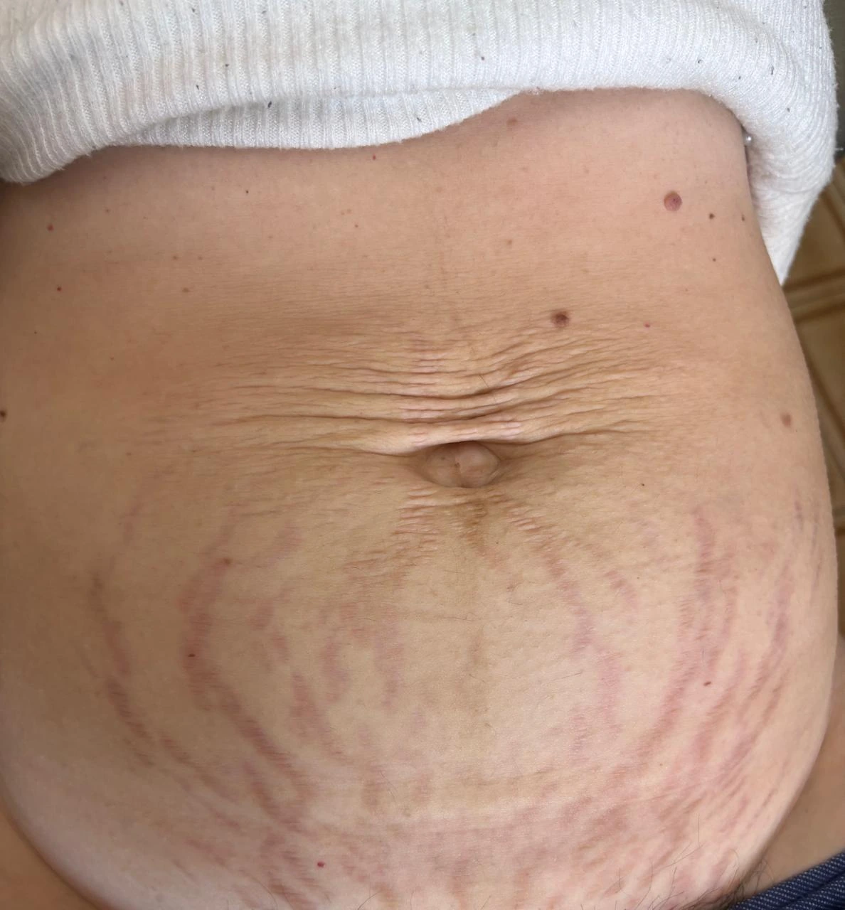Região abdominal antes do cuidado de microagulhamento voltado a estrias