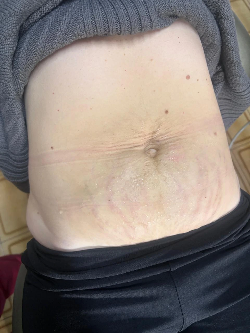 Região abdominal depois do cuidado de microagulhamento voltado a estrias